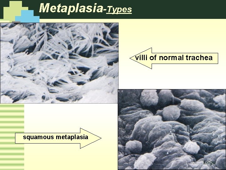 Metaplasia-Types villi of normal trachea squamous metaplasia Logo 