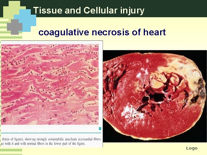 Tissue and Cellular injury coagulative necrosis of heart Logo 