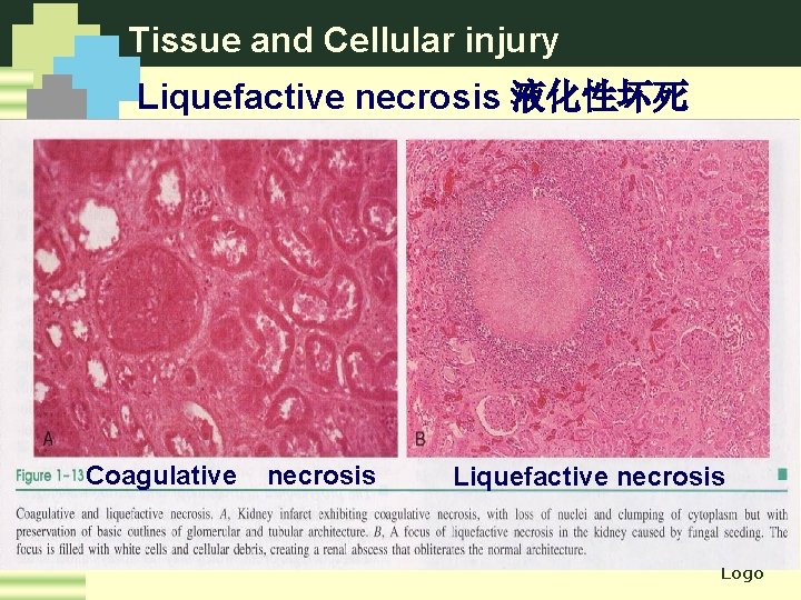 Tissue and Cellular injury Liquefactive necrosis 液化性坏死 Coagulative necrosis Liquefactive necrosis Logo 