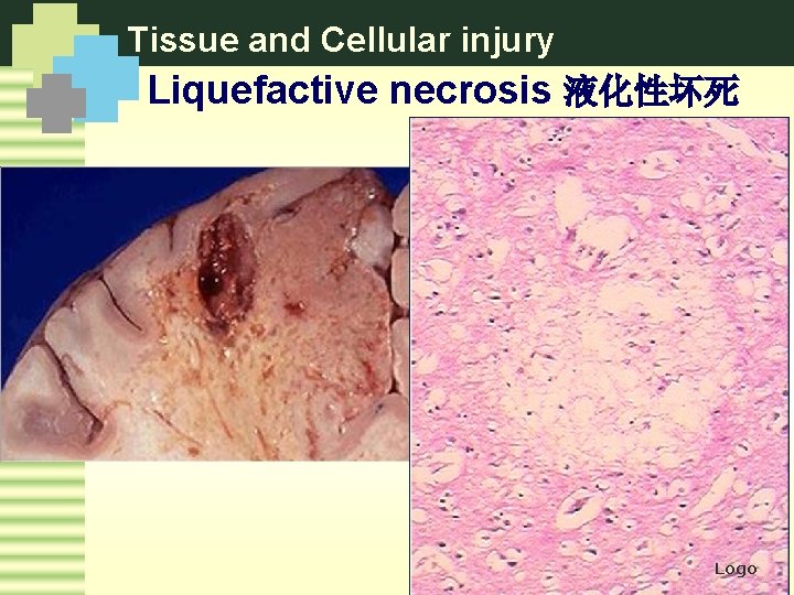 Tissue and Cellular injury Liquefactive necrosis 液化性坏死 Logo 