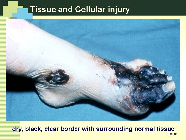 Tissue and Cellular injury dry, black, clear border with surrounding normal tissue Logo 