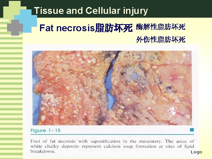 Tissue and Cellular injury Fat necrosis脂肪坏死 酶解性脂肪坏死 外伤性脂肪坏死 Logo 