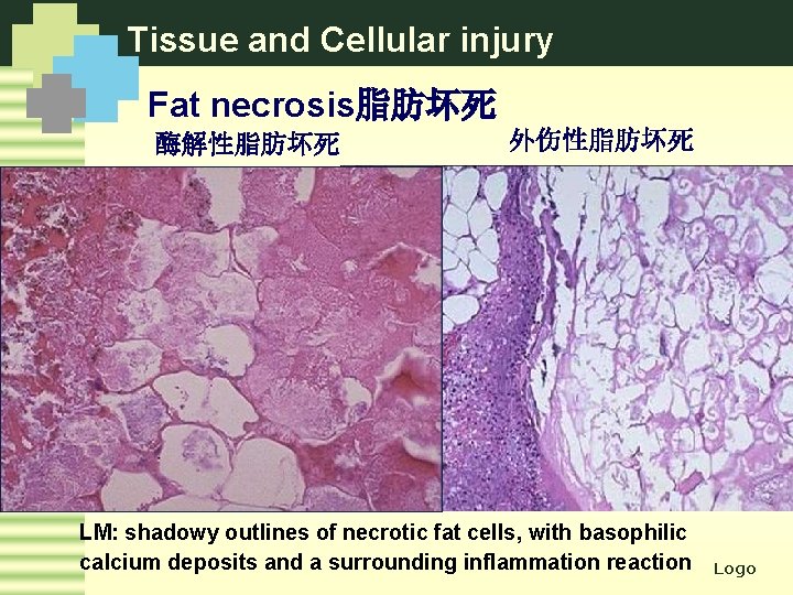 Tissue and Cellular injury Fat necrosis脂肪坏死 酶解性脂肪坏死 外伤性脂肪坏死 LM: shadowy outlines of necrotic fat