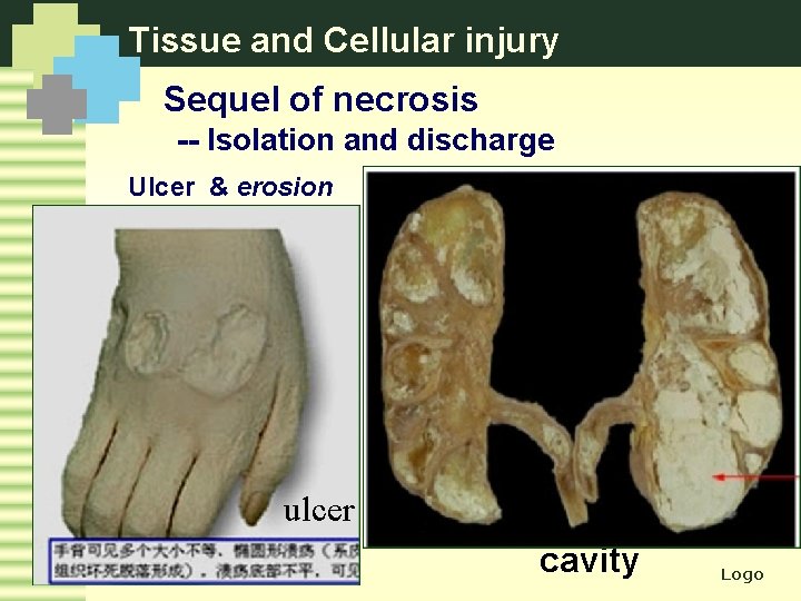 Tissue and Cellular injury Sequel of necrosis -- Isolation and discharge Ulcer & erosion