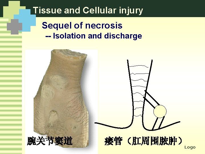 Tissue and Cellular injury Sequel of necrosis -- Isolation and discharge 腕关节窦道 瘘管（肛周围脓肿） Logo