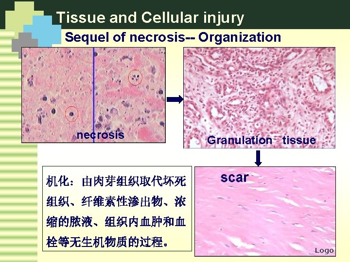 Tissue and Cellular injury Sequel of necrosis-- Organization necrosis Granulation tissue 机化：由肉芽组织取代坏死 组织、纤维素性渗出物、浓 缩的脓液、组织内血肿和血