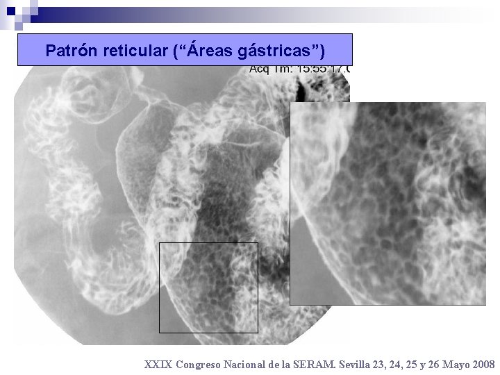 Patrón reticular (“Áreas gástricas”) XXIX Congreso Nacional de la SERAM. Sevilla 23, 24, 25