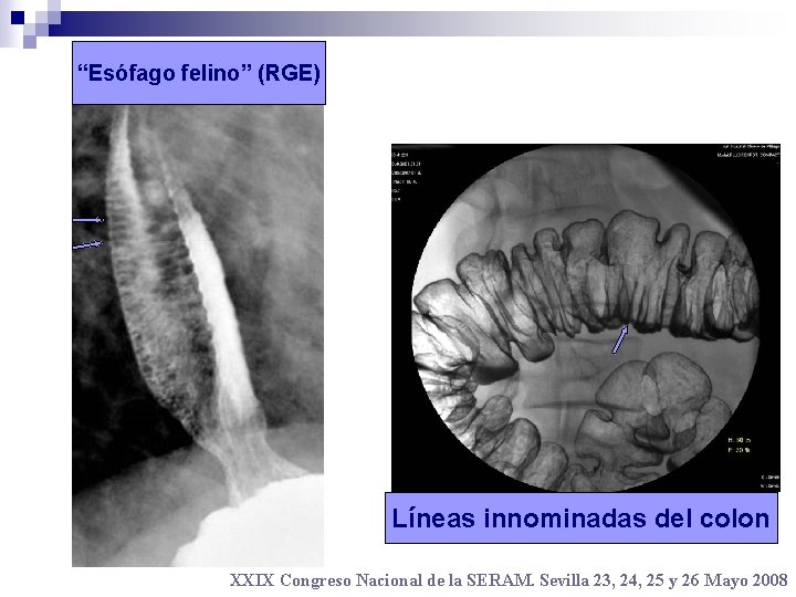 “Esófago felino” (RGE) Líneas innominadas del colon XXIX Congreso Nacional de la SERAM. Sevilla