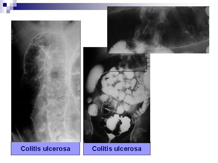 Colitis ulcerosa 