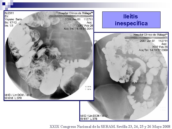 Ileítis inespecífica XXIX Congreso Nacional de la SERAM. Sevilla 23, 24, 25 y 26