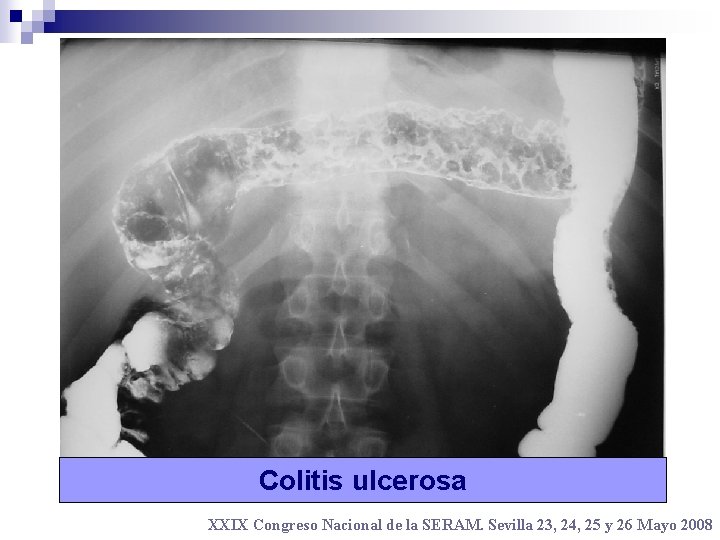 Colitis ulcerosa XXIX Congreso Nacional de la SERAM. Sevilla 23, 24, 25 y 26