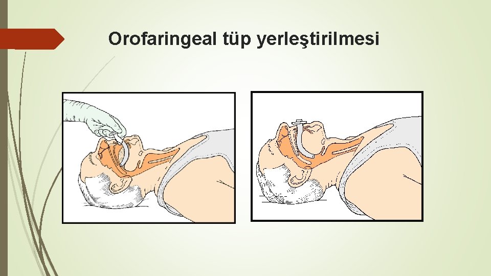 Orofaringeal tüp yerleştirilmesi 