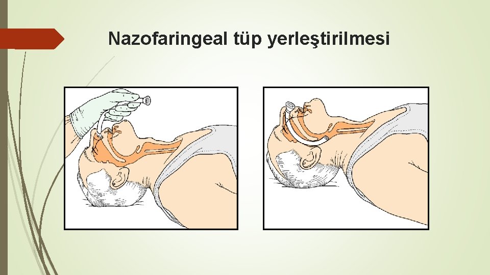 Nazofaringeal tüp yerleştirilmesi 