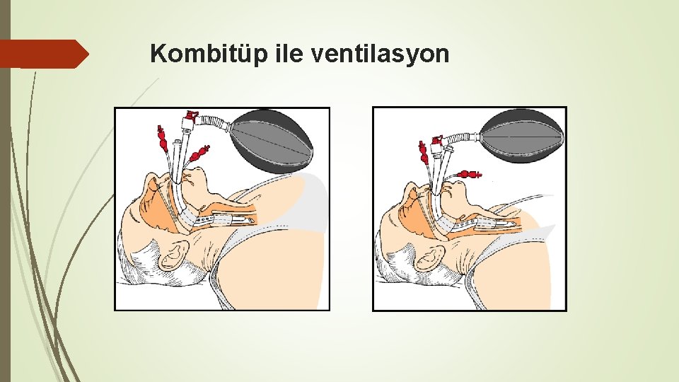 Kombitüp ile ventilasyon 