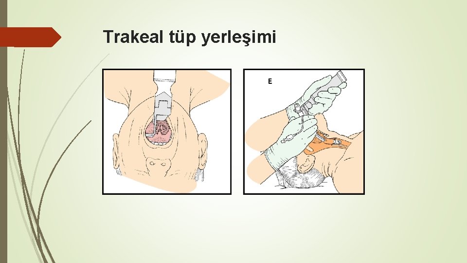 Trakeal tüp yerleşimi 