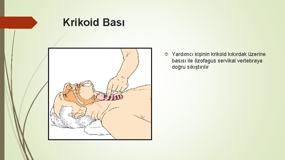 Krikoid Bası Yardımcı kişinin krikoid kıkırdak üzerine basısı ile özofagus servikal vertebraya doğru sıkıştırılır