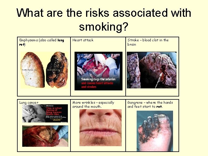 What are the risks associated with smoking? Emphysema (also called lung rot) Heart attack