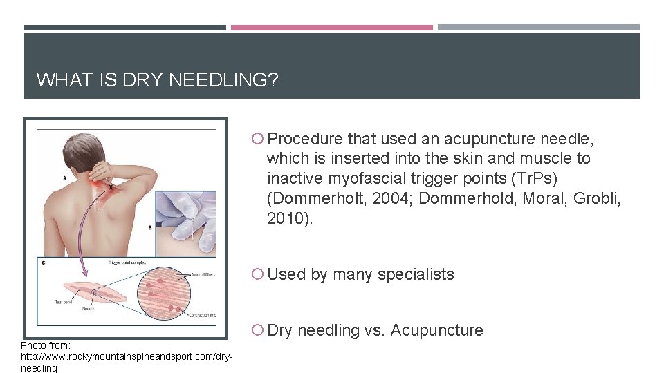 WHAT IS DRY NEEDLING? Procedure that used an acupuncture needle, which is inserted into