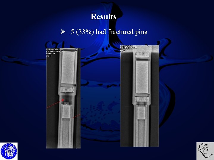 Results Ø 5 (33%) had fractured pins 