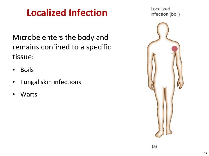 Localized Infection Microbe enters the body and remains confined to a specific tissue: •
