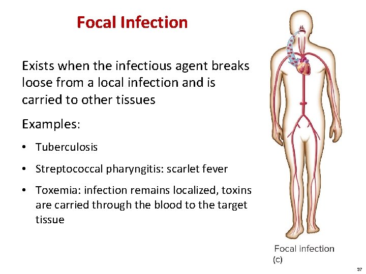 Focal Infection Exists when the infectious agent breaks loose from a local infection and