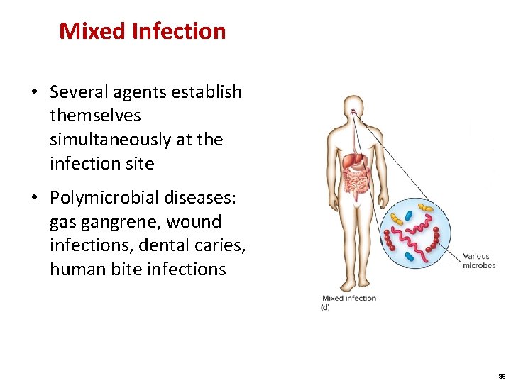 Mixed Infection • Several agents establish themselves simultaneously at the infection site • Polymicrobial