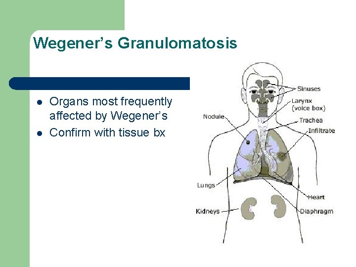 Wegener’s Granulomatosis l l Organs most frequently affected by Wegener’s Confirm with tissue bx Wegener’s Granulomatosis l l Organs most frequently affected by Wegener’s Confirm with tissue bx