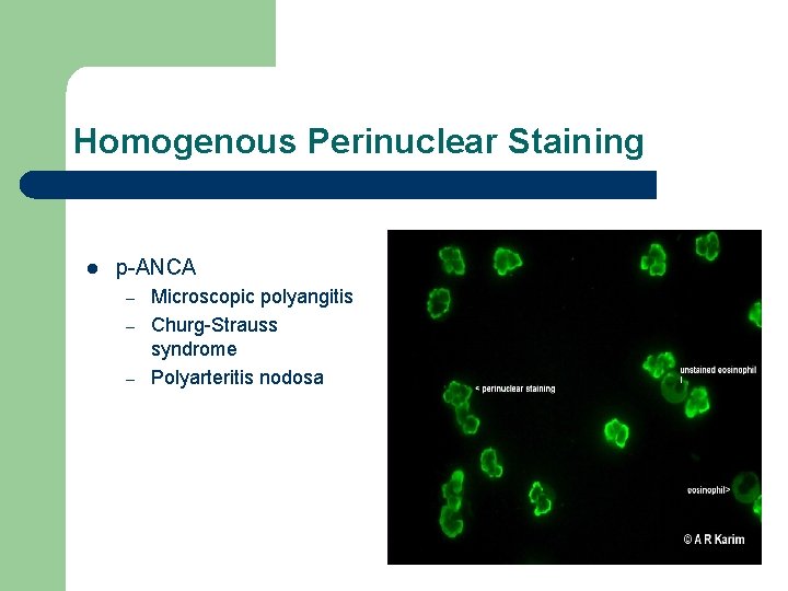 Homogenous Perinuclear Staining l p-ANCA – – – Microscopic polyangitis Churg-Strauss syndrome Polyarteritis nodosa Homogenous Perinuclear Staining l p-ANCA – – – Microscopic polyangitis Churg-Strauss syndrome Polyarteritis nodosa