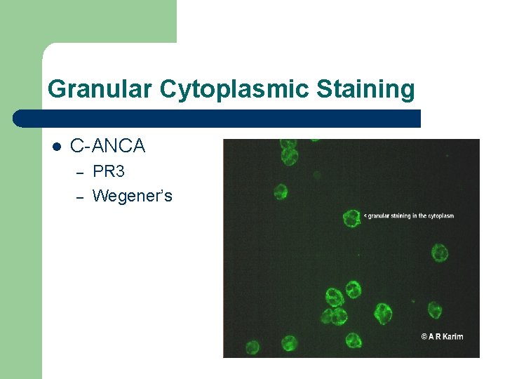 Granular Cytoplasmic Staining l C-ANCA – – PR 3 Wegener’s Granular Cytoplasmic Staining l C-ANCA – – PR 3 Wegener’s