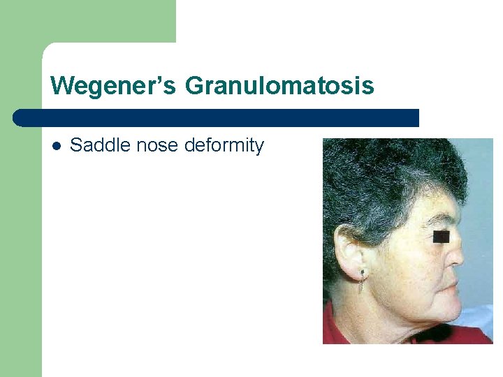 Wegener’s Granulomatosis l Saddle nose deformity Wegener’s Granulomatosis l Saddle nose deformity