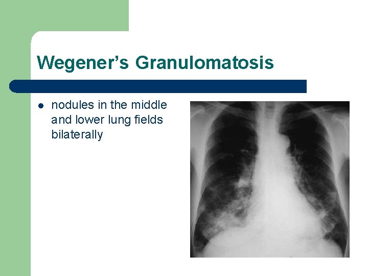 Wegener’s Granulomatosis l nodules in the middle and lower lung fields bilaterally Wegener’s Granulomatosis l nodules in the middle and lower lung fields bilaterally