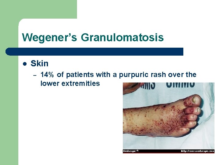 Wegener’s Granulomatosis l Skin – 14% of patients with a purpuric rash over the Wegener’s Granulomatosis l Skin – 14% of patients with a purpuric rash over the
