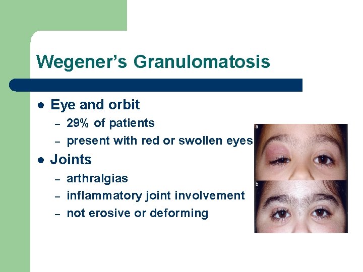 Wegener’s Granulomatosis l Eye and orbit – – l 29% of patients present with Wegener’s Granulomatosis l Eye and orbit – – l 29% of patients present with