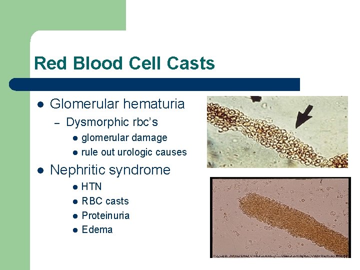 Red Blood Cell Casts l Glomerular hematuria – Dysmorphic rbc’s l l l glomerular Red Blood Cell Casts l Glomerular hematuria – Dysmorphic rbc’s l l l glomerular