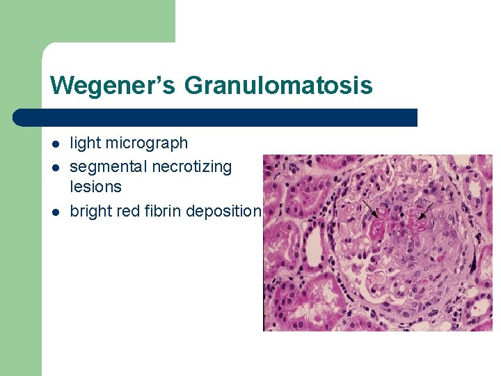 Wegener’s Granulomatosis l light micrograph segmental necrotizing lesions bright red fibrin deposition Wegener’s Granulomatosis l light micrograph segmental necrotizing lesions bright red fibrin deposition