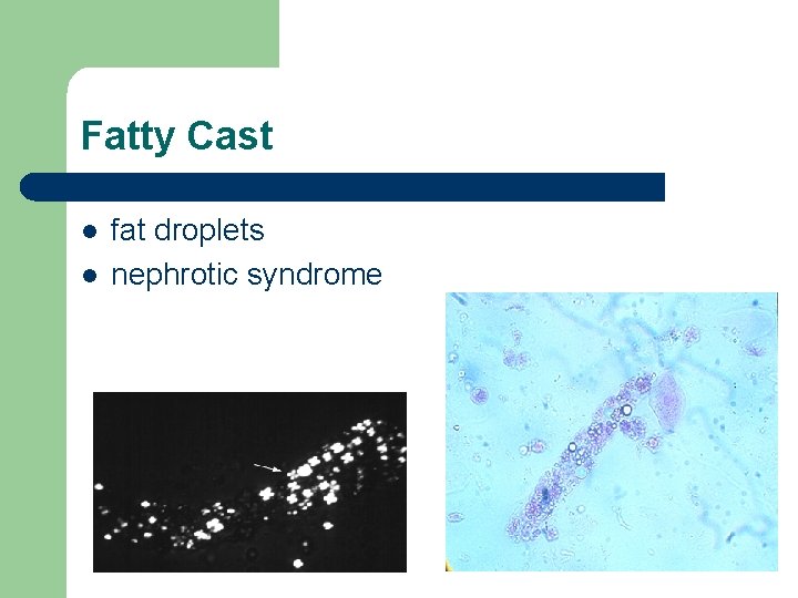 Fatty Cast l l fat droplets nephrotic syndrome Fatty Cast l l fat droplets nephrotic syndrome