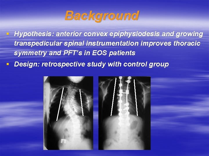 Background § Hypothesis: anterior convex epiphysiodesis and growing transpedicular spinal instrumentation improves thoracic symmetry