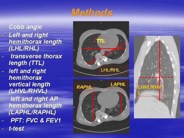 Methods - Cobb angle - Left and right hemithorax length (LHL/RHL) - transverse thorax