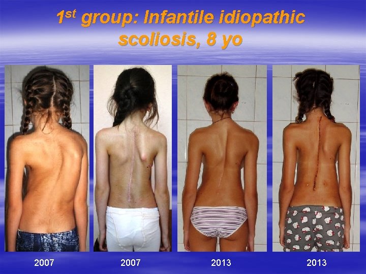 1 st group: Infantile idiopathic scoliosis, 8 yo 2007 2013 