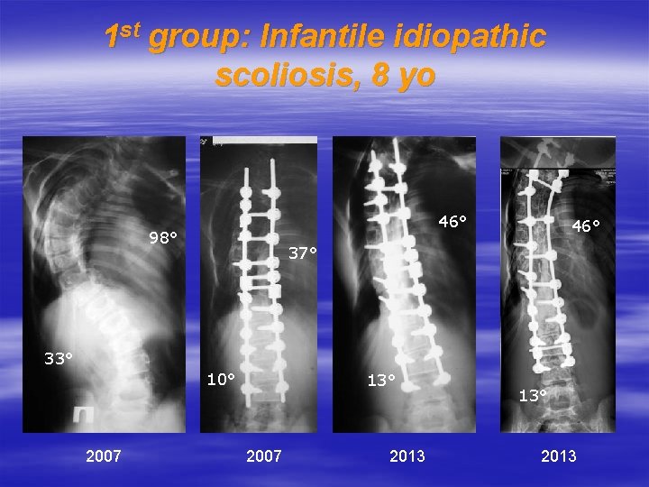 1 st group: Infantile idiopathic scoliosis, 8 yo 46° 98° 46° 37° 33° 10°