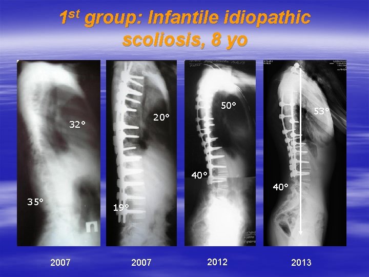 1 st group: Infantile idiopathic scoliosis, 8 yo 50° 53° 20° 32° 40° 35°