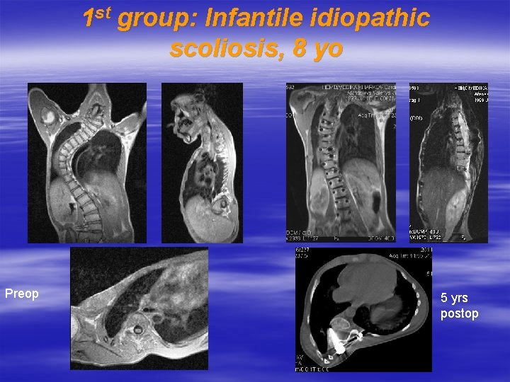 1 st group: Infantile idiopathic scoliosis, 8 yo Preop 5 yrs postop 