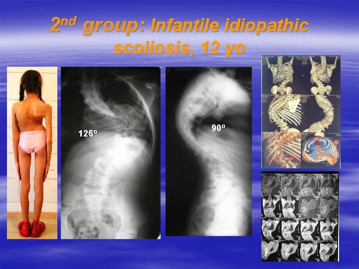 2 nd group: Infantile idiopathic scoliosis, 12 yo 126º 90º 