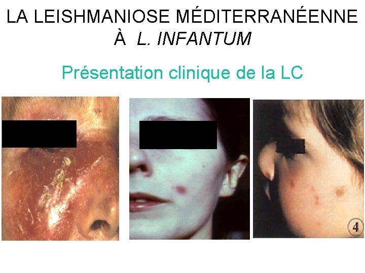 LA LEISHMANIOSE MÉDITERRANÉENNE À L. INFANTUM Présentation clinique de la LC 