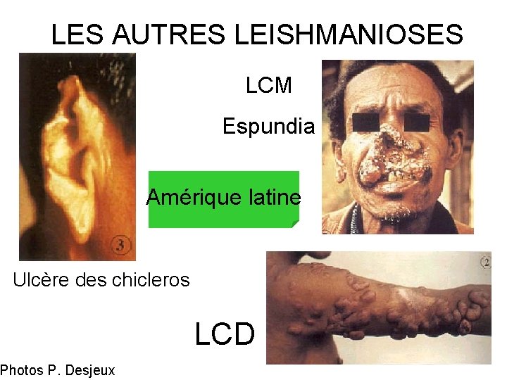 LES AUTRES LEISHMANIOSES LCM Espundia Amérique latine Ulcère des chicleros Photos P. Desjeux LCD