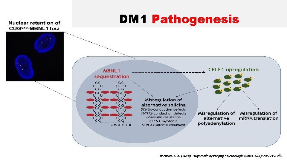 DM 1 Pathogenesis Thornton, C. A. (2014). "Myotonic dystrophy. " Neurologic clinics 32(3): 705