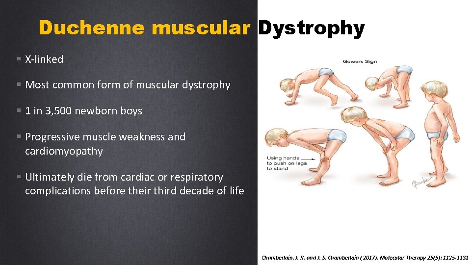 Duchenne muscular Dystrophy § X-linked § Most common form of muscular dystrophy § 1