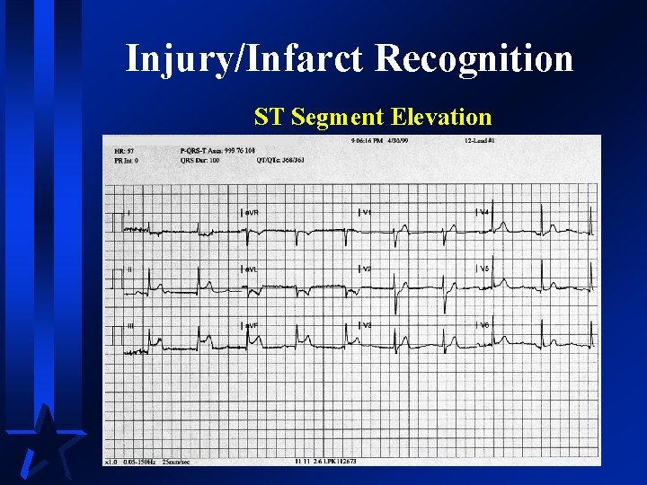 Injury/Infarct Recognition ST Segment Elevation 