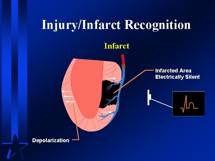 Injury/Infarct Recognition Infarcted Area Electrically Silent Depolarization 