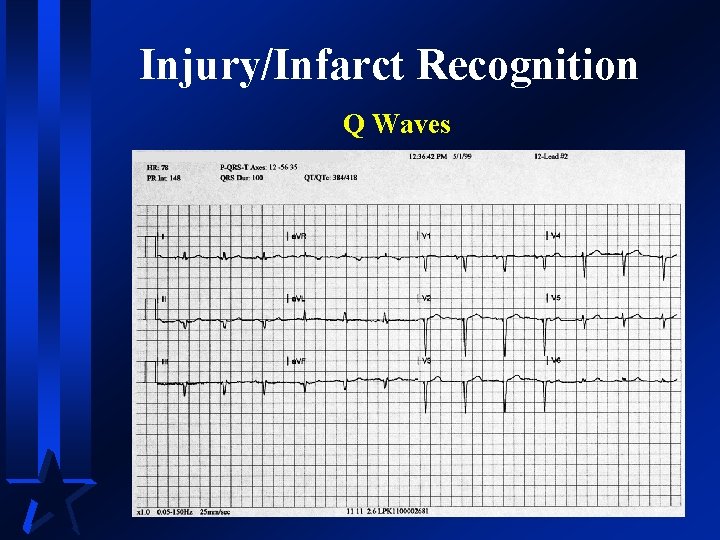 Injury/Infarct Recognition Q Waves 
